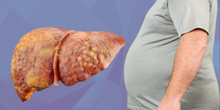 মাত্র ৬০ দিনে নির্মূল হবে ফ্যাটি লিভার, খাদ্য তালিকায় রাখুন এই ৫ খাবার